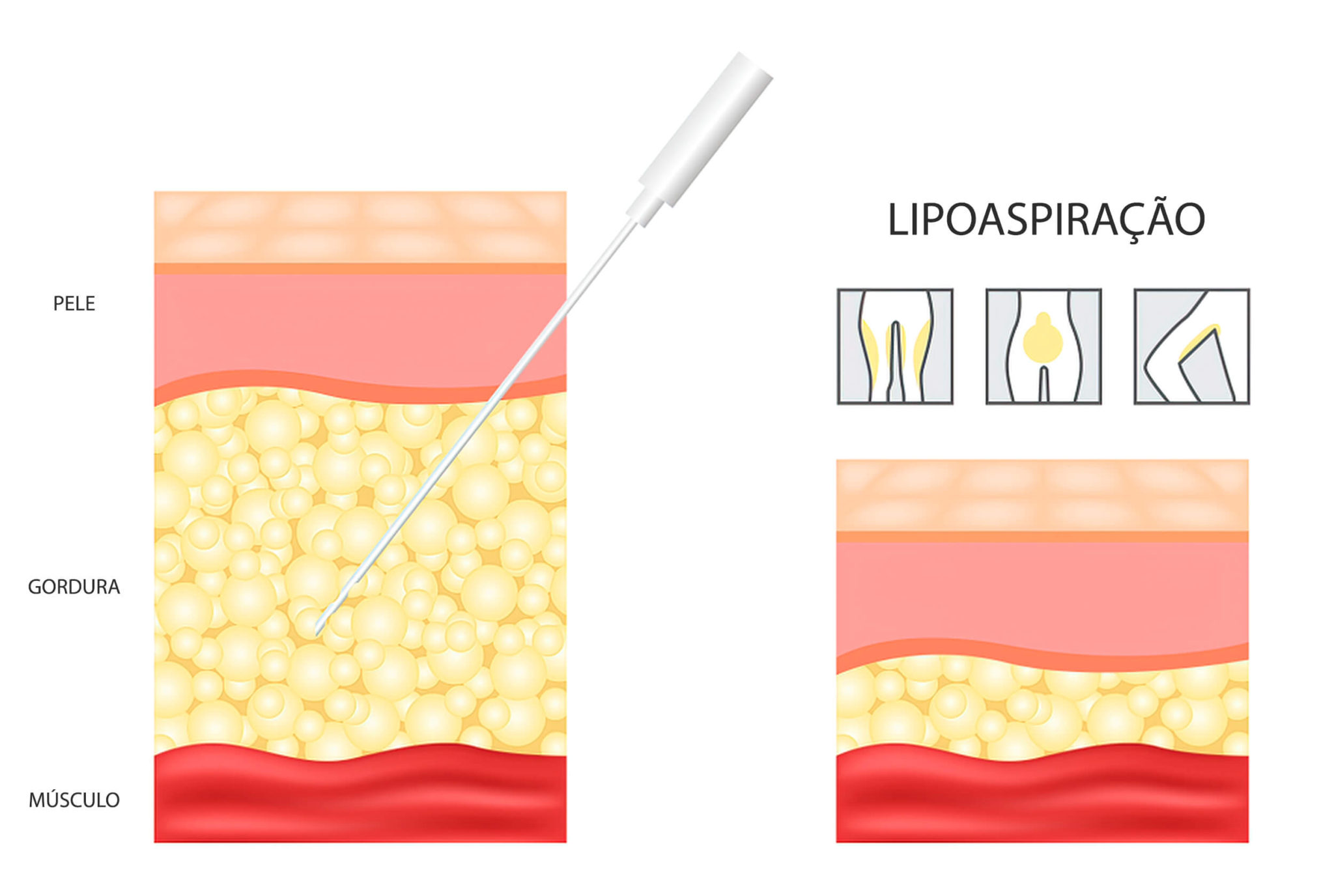 Lipoaspiração - Dr. José Renato Leite